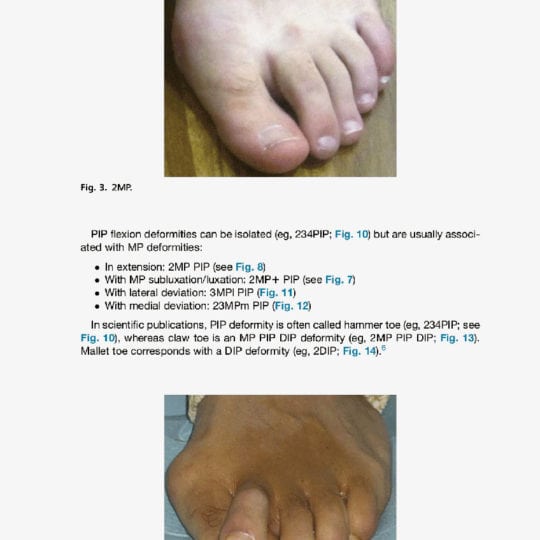 article-technique-percutanee-deformations-des-orteils-lateraux4