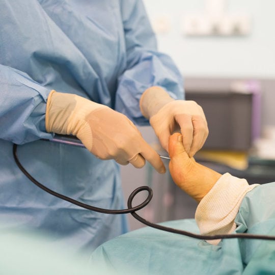 Chirurgie percutanée du pied